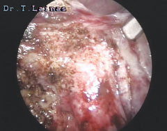 Sublimation of ovarian endometrioma. Detail of sublimation (laparoscopic image).